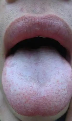 舌头白白的,貌似是毛一样的东西,怎么回事