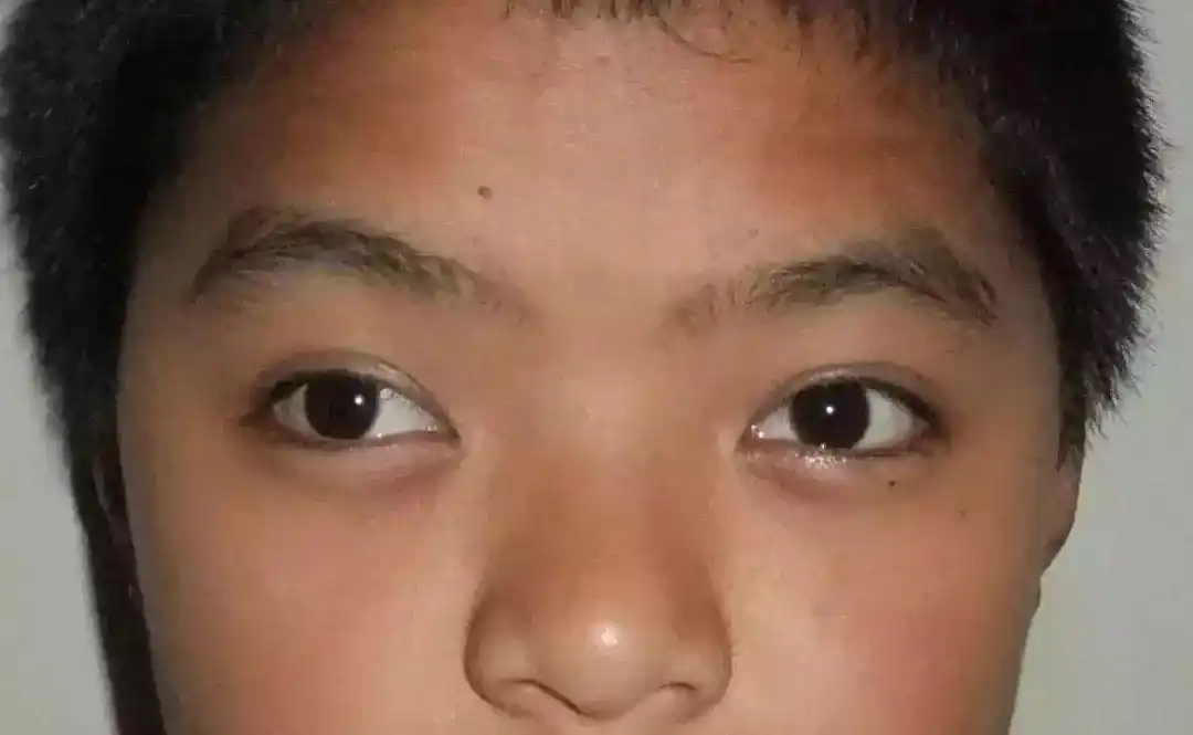 角膜靠近过外眼角方向显性内斜视:光点在角膜正中央正视眼和隐斜视眼