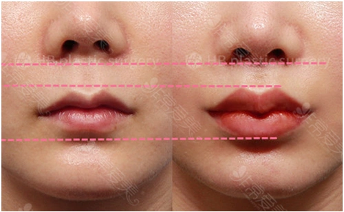 hb医院人中整形