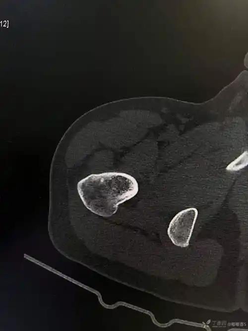 各位老师这个是股骨头滑膜疝吗