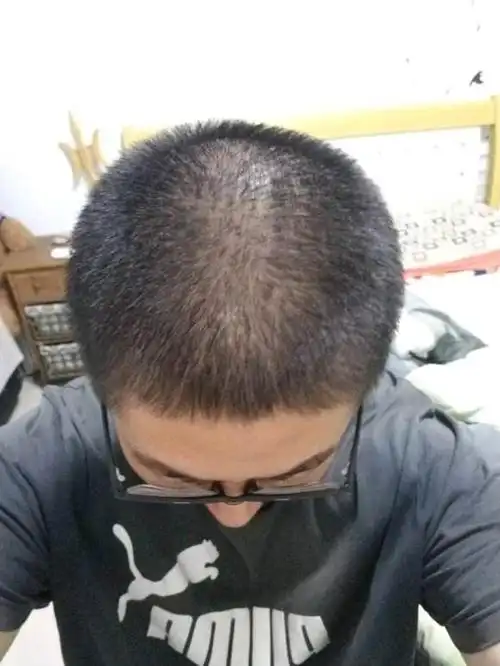 怎样可以治疗脱发 治疗女性脱发最好的药