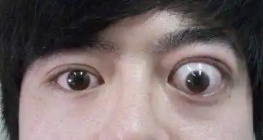 华西论健 | 眼睛又突又大 警惕是你有病