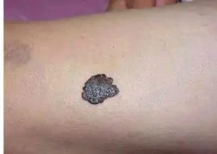 黑素瘤与痣的区别图_良性痣图片