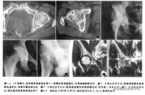 【影像拾遗】这个病变你可能不陌生,但真的了解它吗?