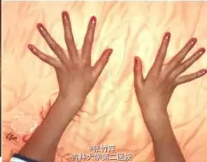 马凡综合征一例