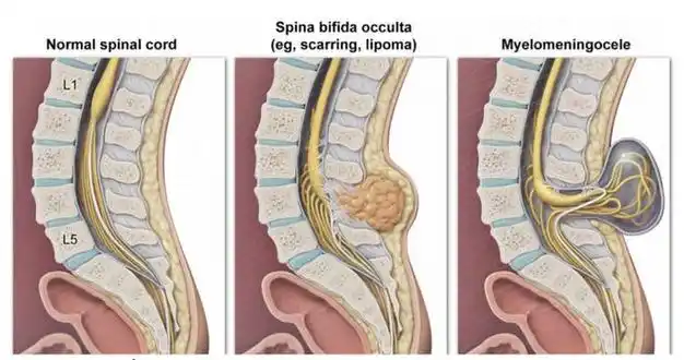 宝宝屁股上的小坑,可能会引起瘫痪