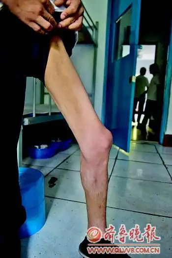 ◤30岁的彝族小伙吸毒十年,如今已是骨瘦如柴.