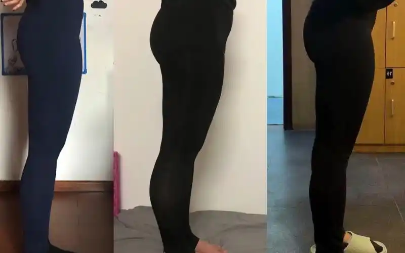 大腿前侧过于凸出的分析及矫正逻辑