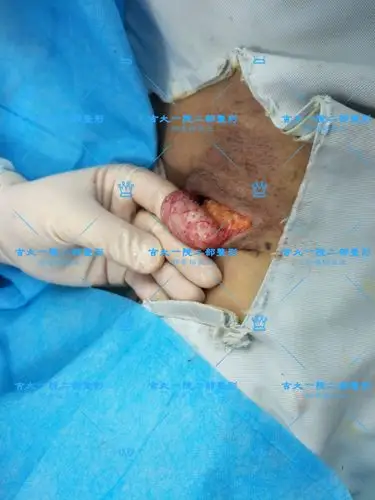 腋臭(狐臭) - 好大夫在线