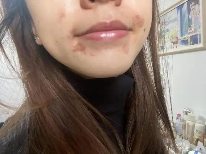 去医院刷酸感觉被烧伤了……有做过的朋友帮忙看下.