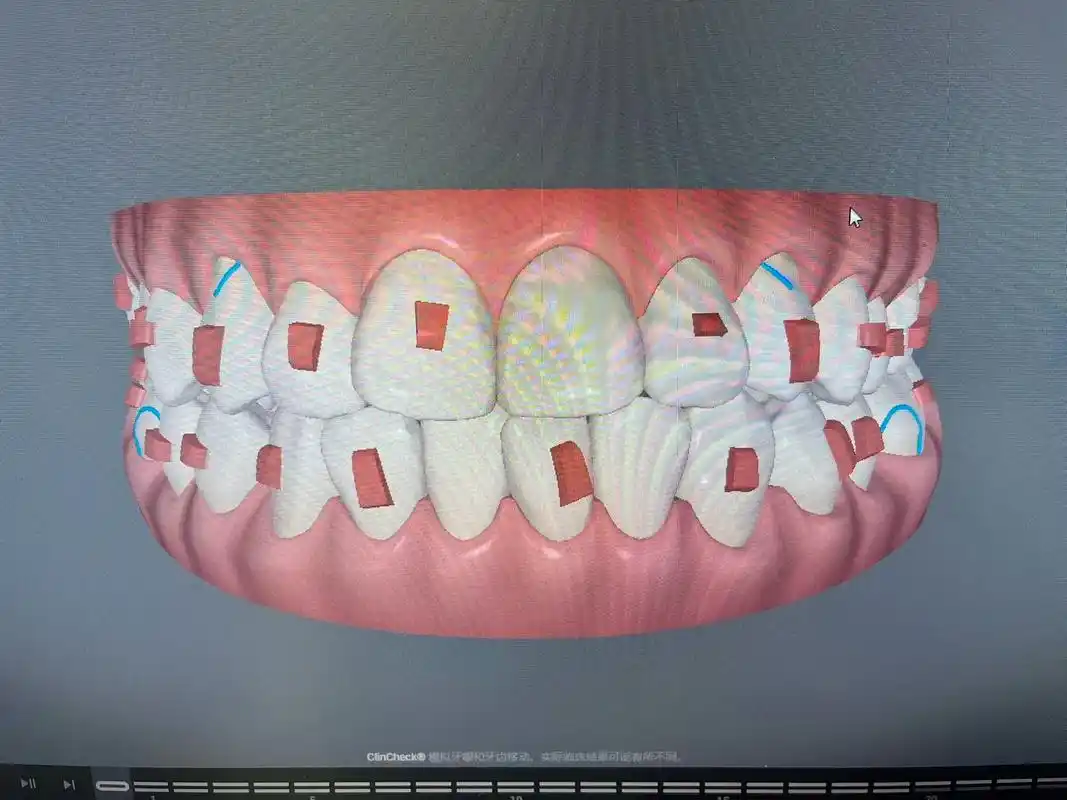 隐形矫正,看我的效果图,这带了一年哈.继续追加精细#牙齿07 - 抖音