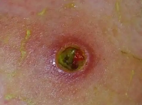 5岁女儿患"皮肤癌",医生查明原因后,宝妈后悔不该这么做