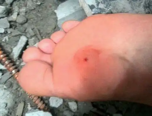 在破伤风的众多原因中,其中最严重的就是被钉子扎破脚,钉子扎到脚,会