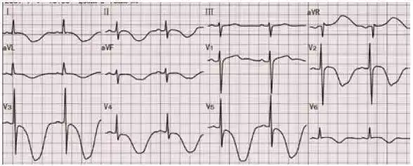 如何鉴别巨大倒置t波