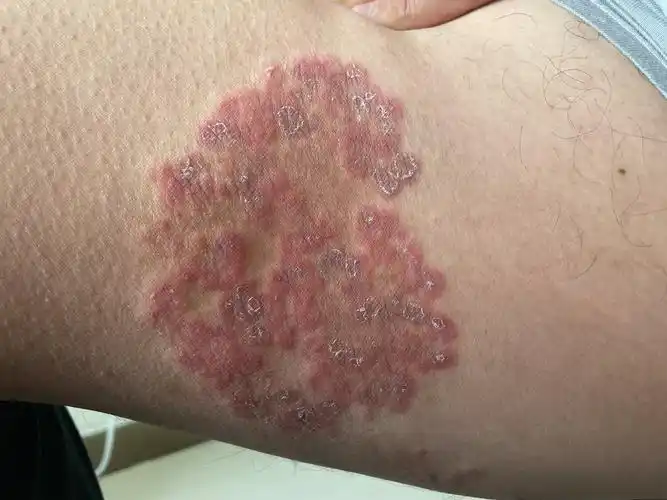 看图识病:股癣 - 好大夫在线