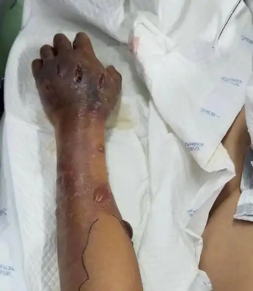 广西阿伯带伤洗鱼后手臂黑裂长泡最后惨遭截肢