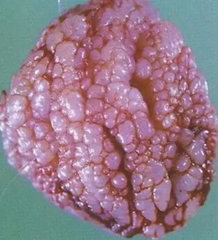 男性经常发于【冠状沟】,【龟头】,【包皮】,【系带】,【尿道口】