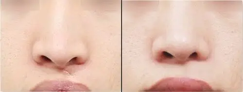 唇裂修复手术前后对比图