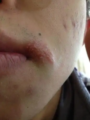 嘴角长了这个东西 有点疼 是什么?