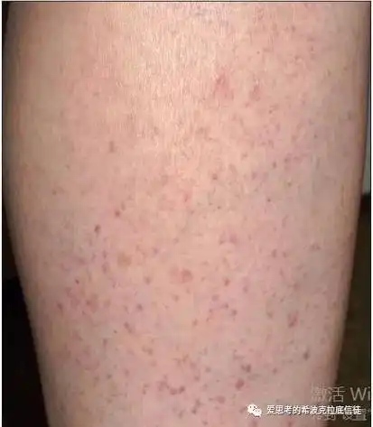 皮肤的异常干燥和瘙痒是常见症状;13%-30%的干燥患者有雷诺现象;皮肤