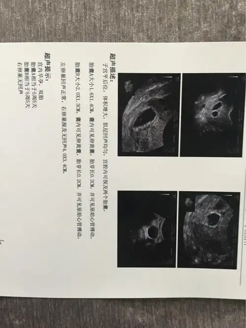 40天双胎宝宝胎心来了.只看楼主