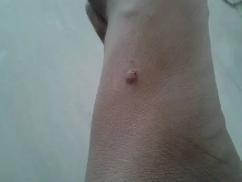 脚背长肉粒是什么怪病