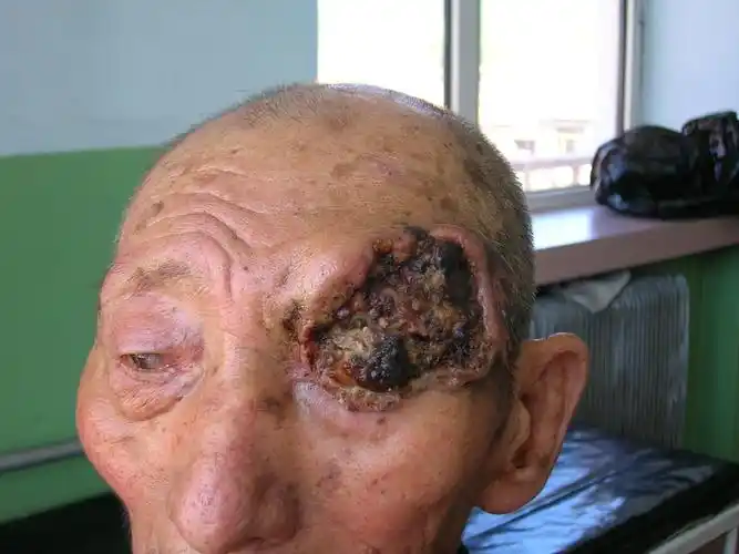 发个皮肤癌的看看