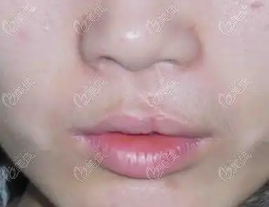 兔唇修复术后留下细小的线性疤痕