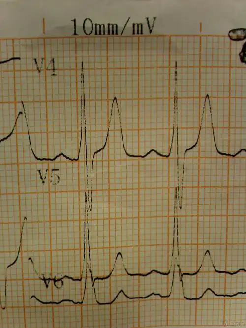 急急急急急急请教各位下列心电图诊断是什么该如何处理