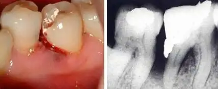 牙髓炎有哪些症状