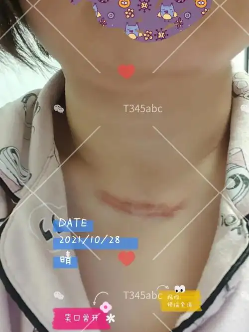 甲状腺手术疤痕增生