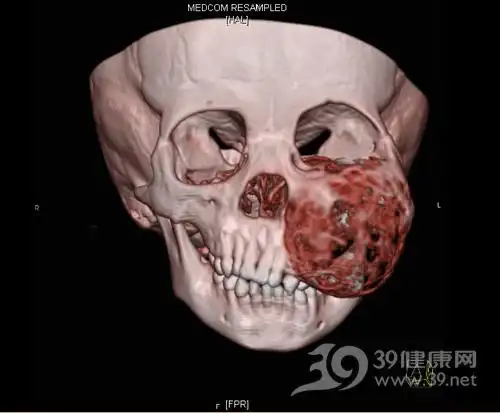 2岁宝宝口腔长大肿瘤 "超显微"颌面功能重建手术助她新生_39健康网
