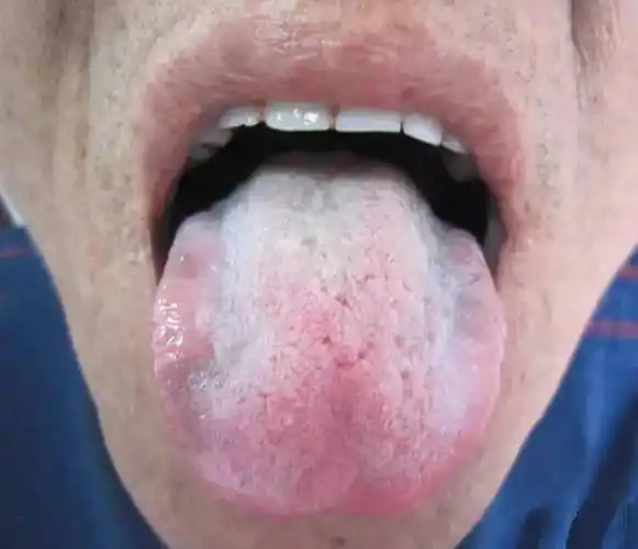 看舌头就能知道自己的健康状况快来专家教你舌诊啦