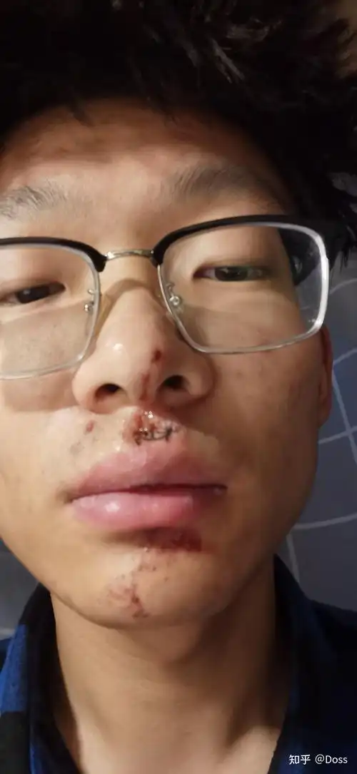 嘴唇创伤碎碎念