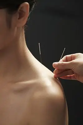 治疗肩周炎,针灸,小针刀都值得一试  图/视觉中国