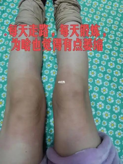 是有点肌肉萎缩吗