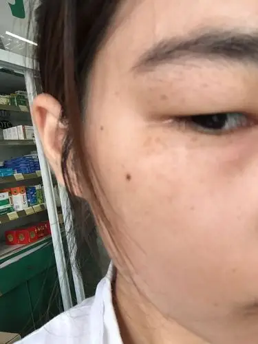 二十二岁还没结婚眼睛周边长斑叫什么斑 想去看医生 也不知道挂什么科