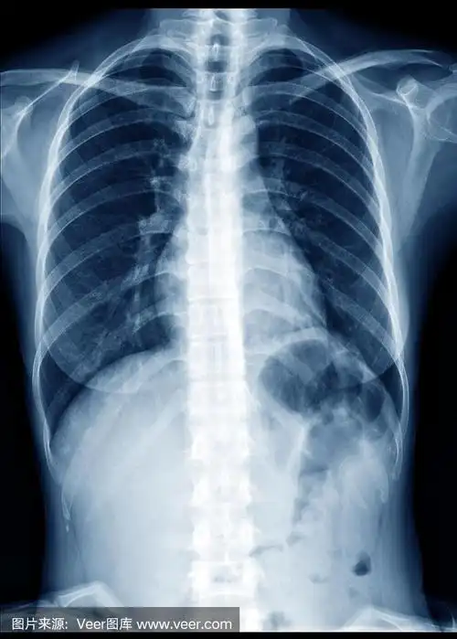 正常健康女性的胸部x光片显示肺,心脏,脊柱,锁骨,隔膜