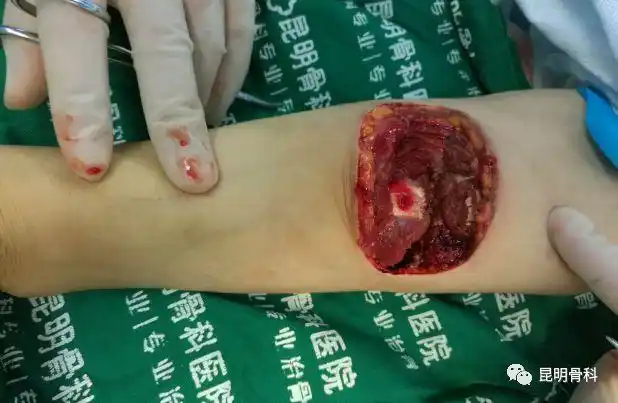 惊!老汉被工友锯断手臂