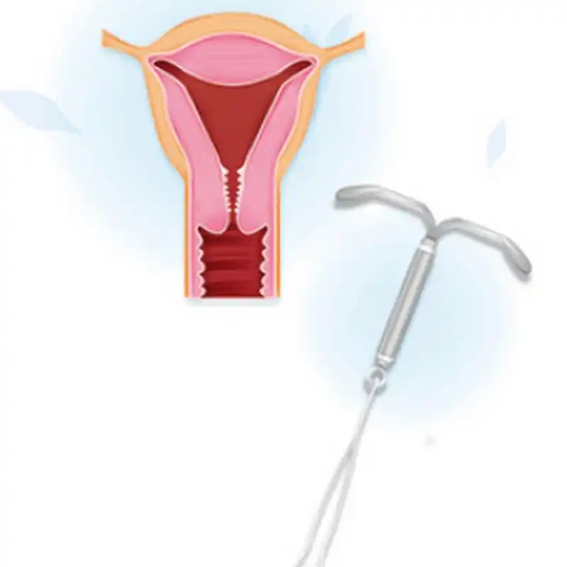 上曼月乐环前,这三点应该先了解#腺肌症#  得了腺肌症的姐妹都想上