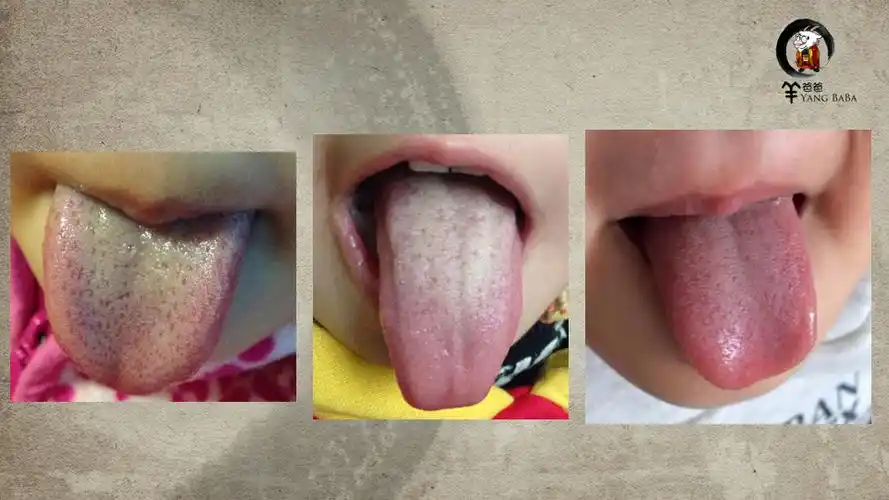 小儿积食发烧分享