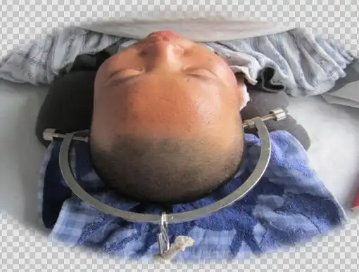 骨牵引术的注意事项