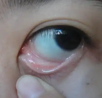 十年前就有眼睛偶尔会出现一团半环形的闪