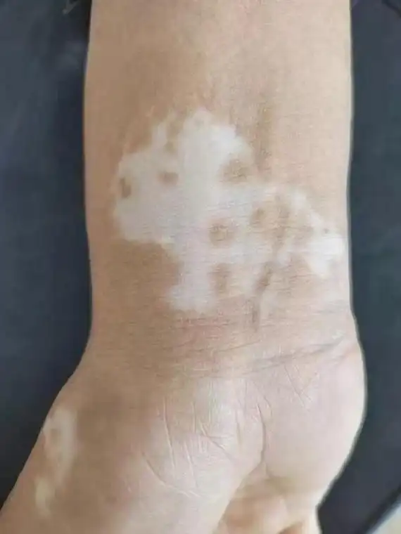 白斑病不等于"白癜风" 儿童皮肤问题需科学辨识