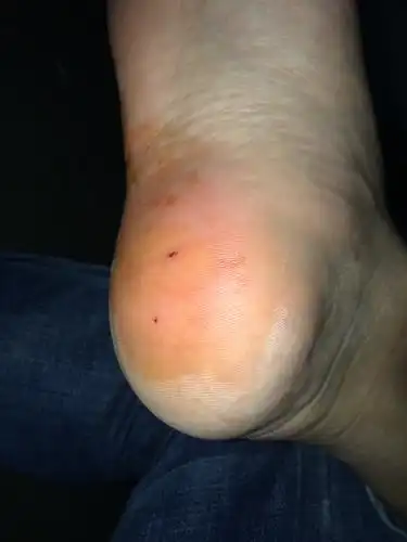 今天在工地不小心踩到钉子(生锈),把鞋刺穿后刺入脚后跟.深度大约1.