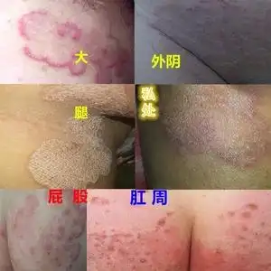 8男性私处发炎阴囊阴茎长痘痘颗粒珍珠诊包皮龟头发红斑点同房破