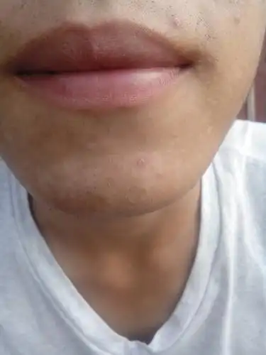 谁知道下巴长这样的白斑是怎么回事啊?不懂的不要吓我