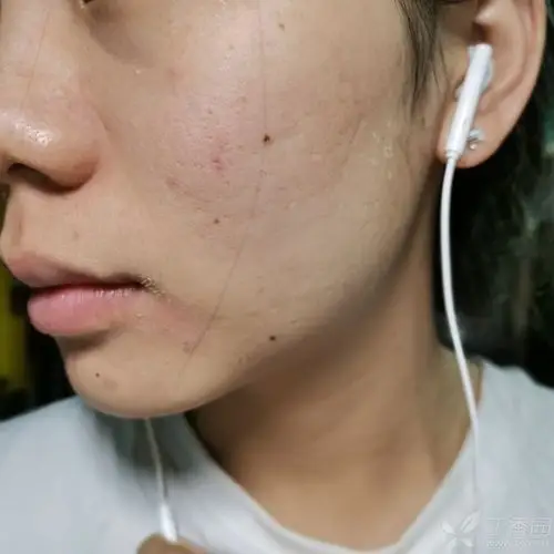 我是真菌易感体质,不知道也没有什么类型的真菌感染是这种表现.