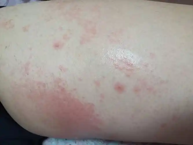 问:身上长了一片这种疹子,是不是过敏了?