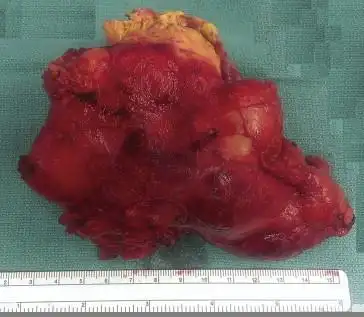 罕见前纵隔巨大滑膜肉瘤1例